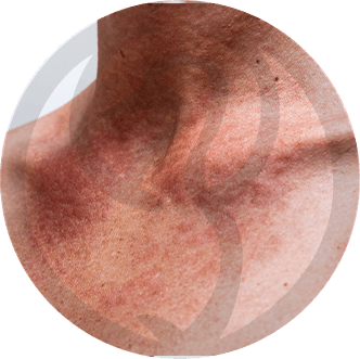 Fotossensibilidade - Clinica Derma Lineexplica o que é