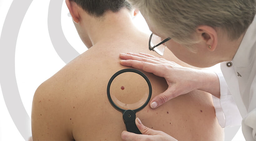 Melasma Imagem Melasma