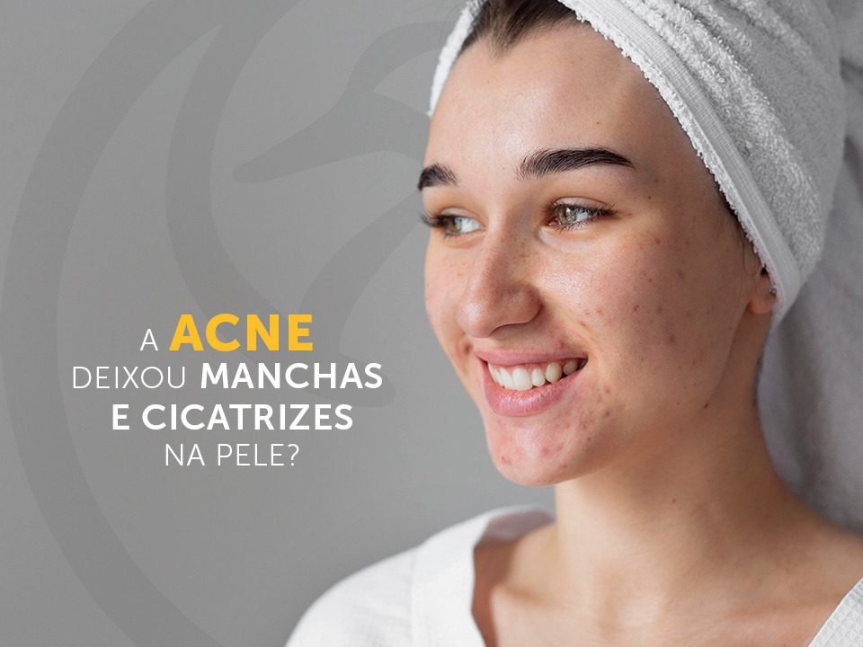 Acne – Causas da Acne em Cada Parte do Rosto - Derma Line