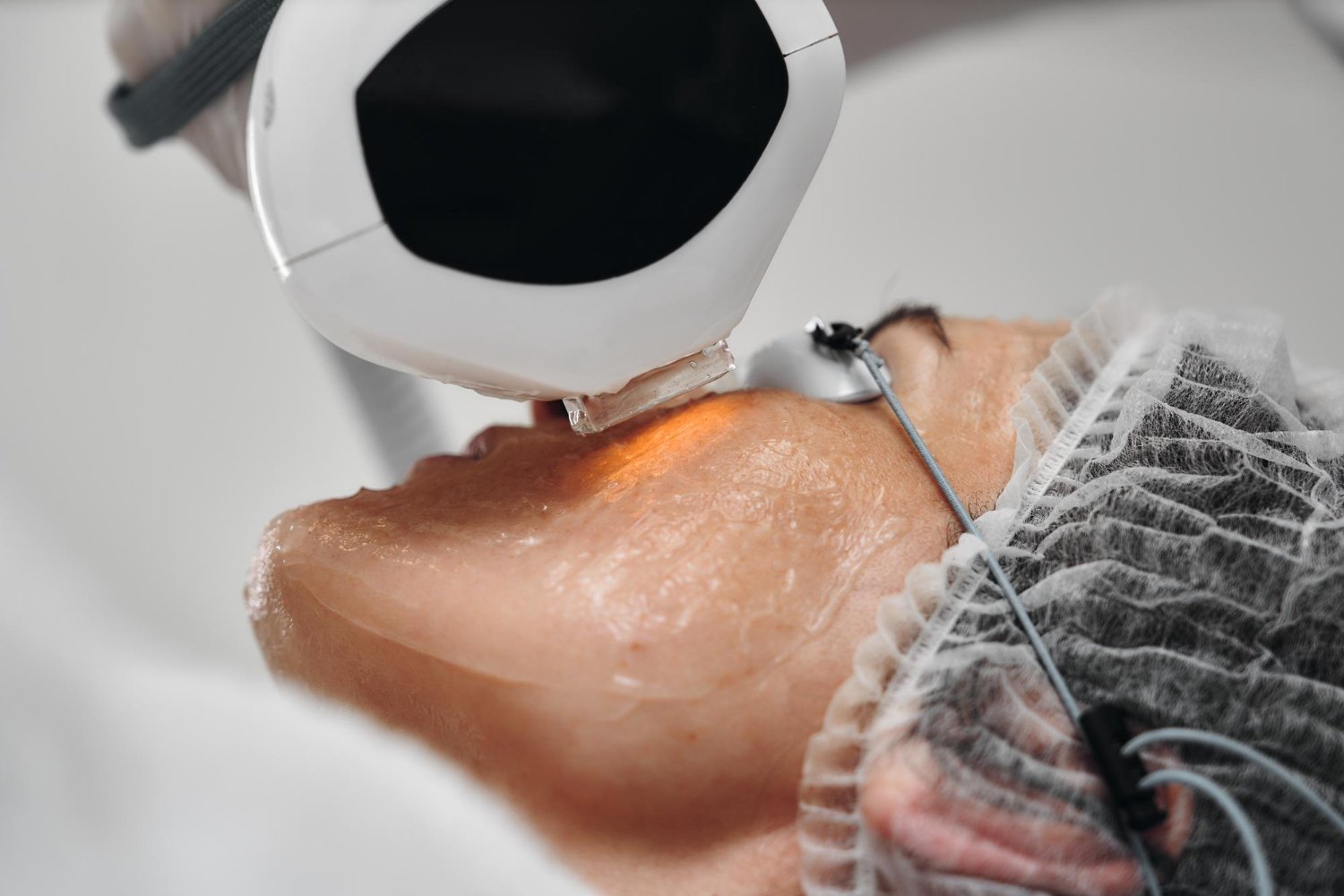 skin laser