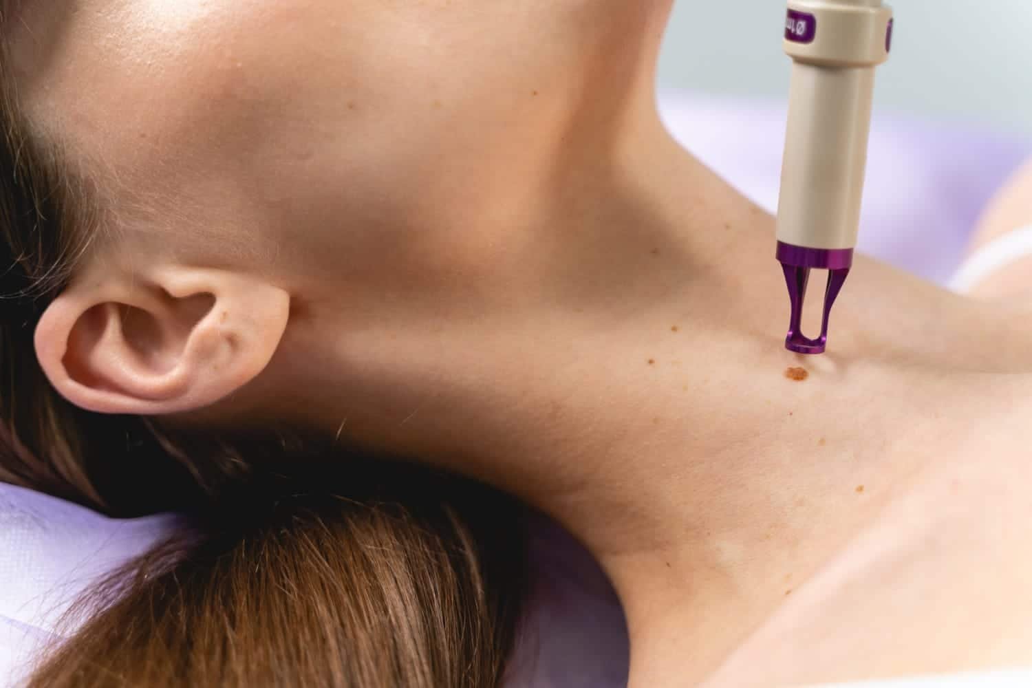 remoção de verrugas