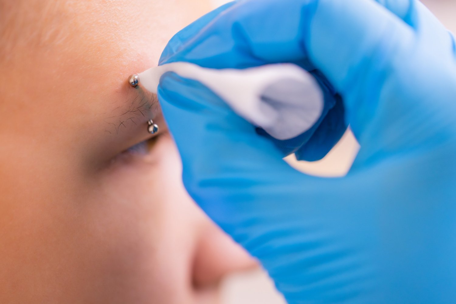 queloide em piercing sobrancelha - derma line