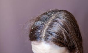 dermatite seborréica