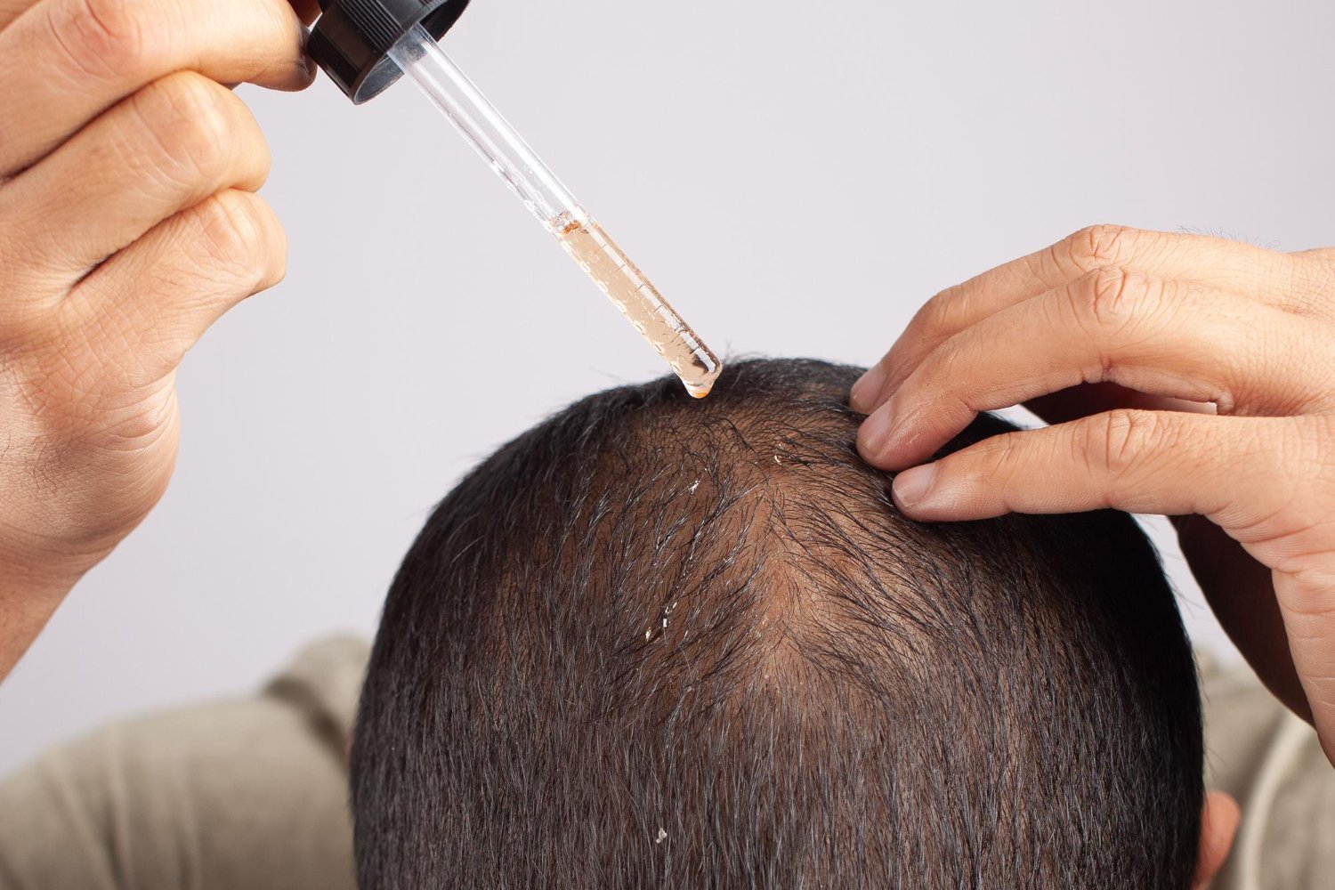 minoxidil homem