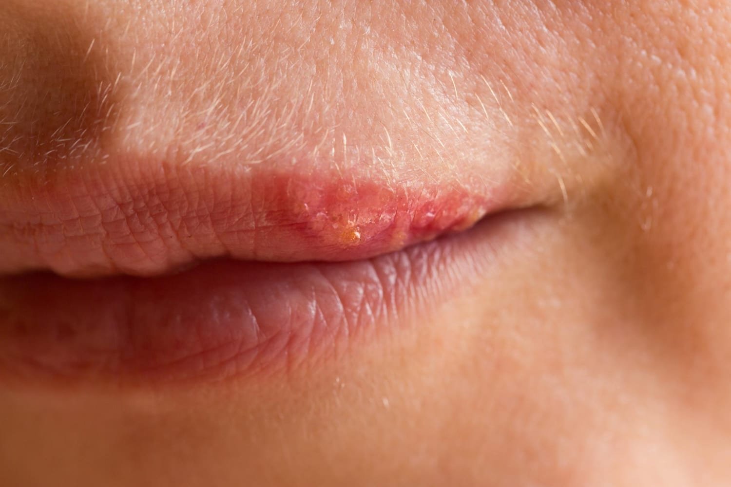 tratamento herpes labial