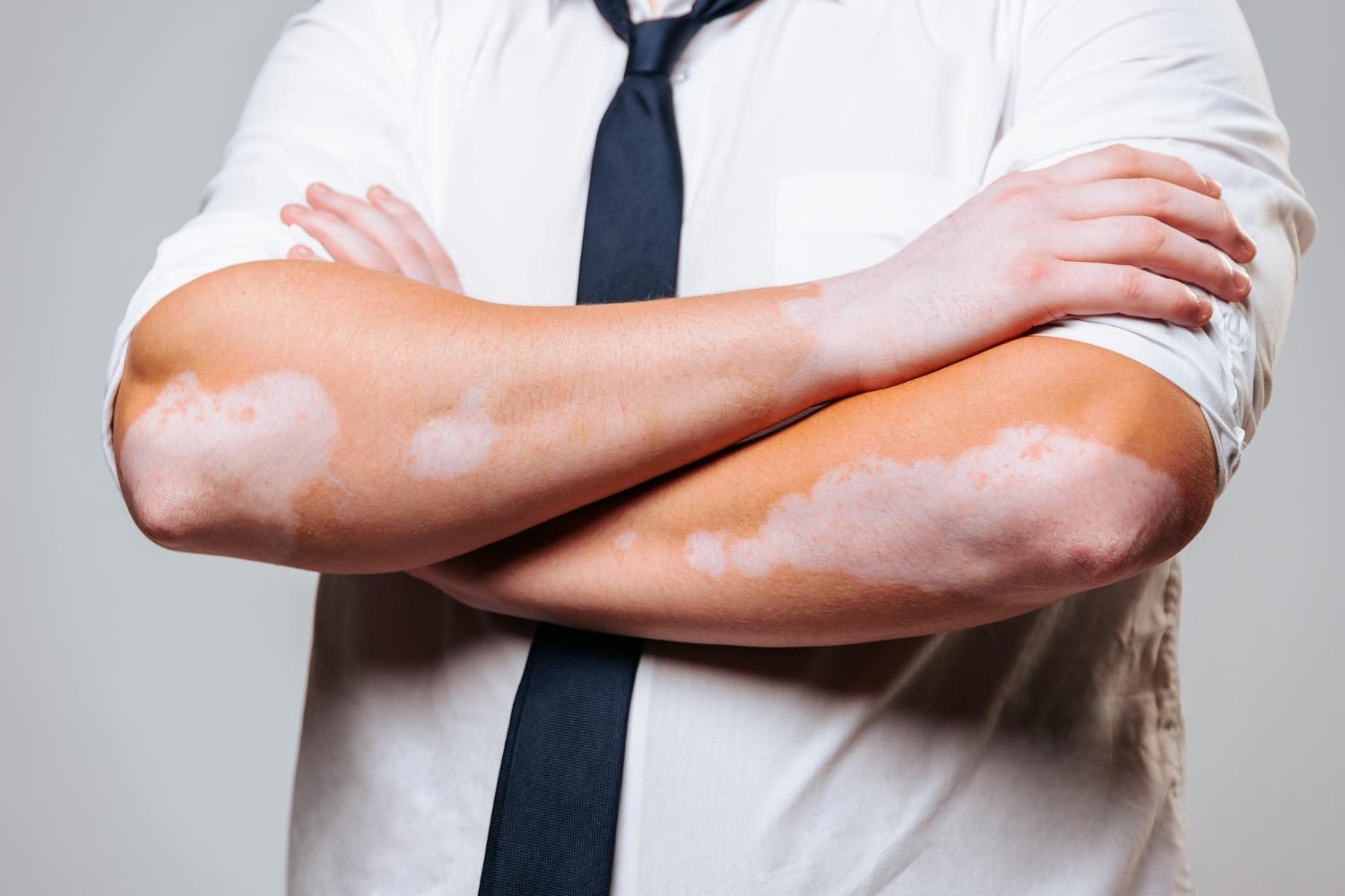 vitiligo tem cura