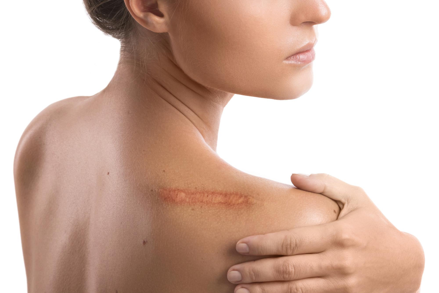 queloide ou granuloma