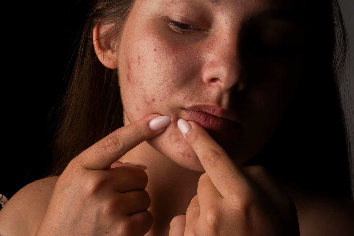 acne persistente