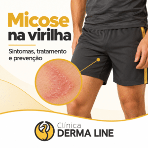Ilustração sobre micose na virilha, com destaque para sintomas, tratamento e prevenção.